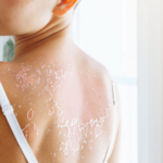 Understanding Sunburn: More Than Just Red Skin 