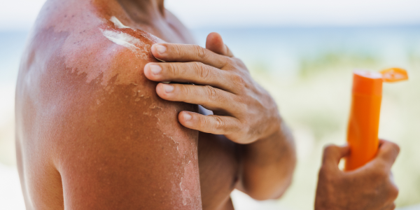 Understanding Sunburn - More than just red skin